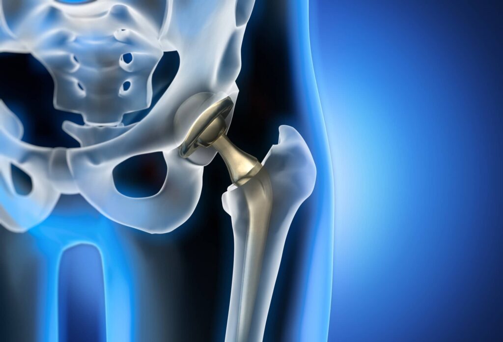 Hip Labral Repair vs Reconstruction | CSOG