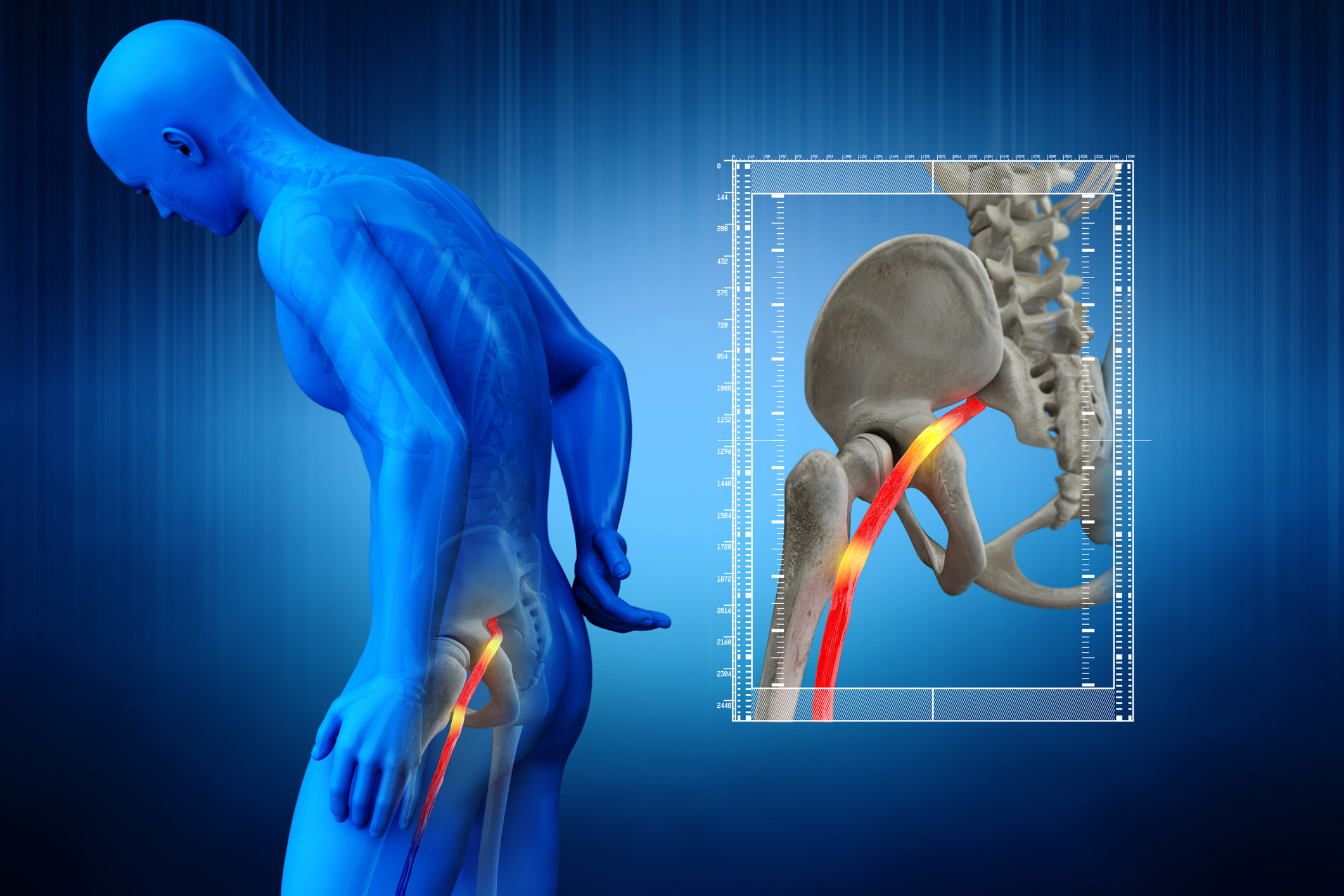 Physical Therapy for Sciatica in Colorado Springs | CSOG