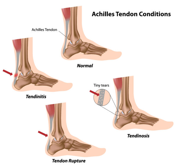 The Importance of Foot and Ankle Flexibility - Foot and Ankle Group