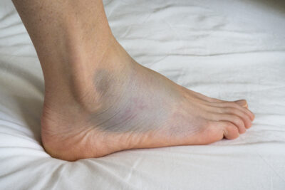 Sprained Ankle? Learn how to treat a Sprained Ankle