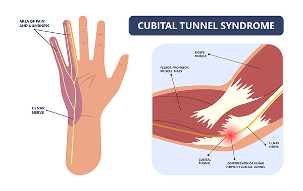 Ulnar Nerve Entrapment (Cubital Tunnel Syndrome)