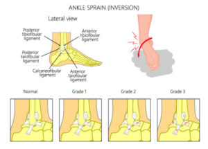 Sprained Ankle? Learn how to treat a Sprained Ankle