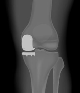 Total Knee Replacement Vs Partial Knee Replacement - Colorado Springs ...